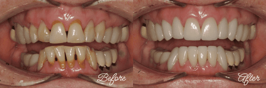 Before and After dental crowns 