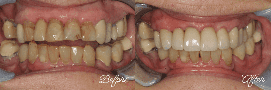 Before and After dental crowns