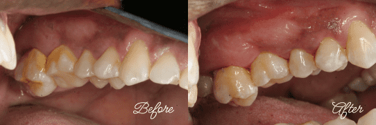 Dental Cleaning Before and After