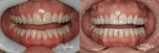 Before and After Clear Aligners in Fairfax, Virginia