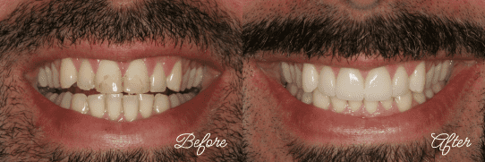 Before and After Dental Veneers