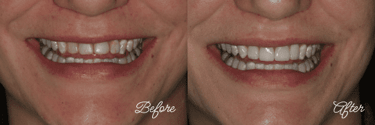 Before and After Veneers in Fairfax, Virginia
