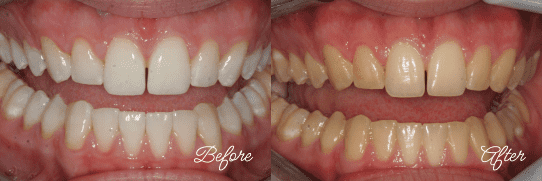 Before and After Teeth Whitening in Fairfax, Virginia
