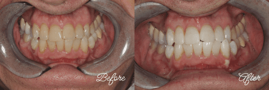 Teeth Whitening in Fairfax, Virginia