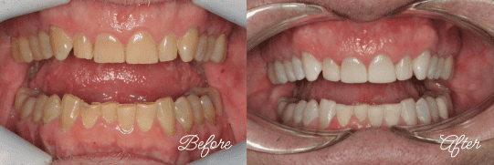 Teeth Whitening Results in Fairfax, Virginia